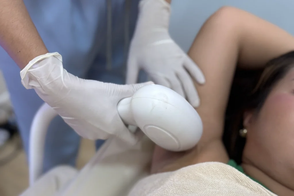 คุณหมอเอกกำลังทำเลเซอร์กำจัดขนด้วย Diode Laser