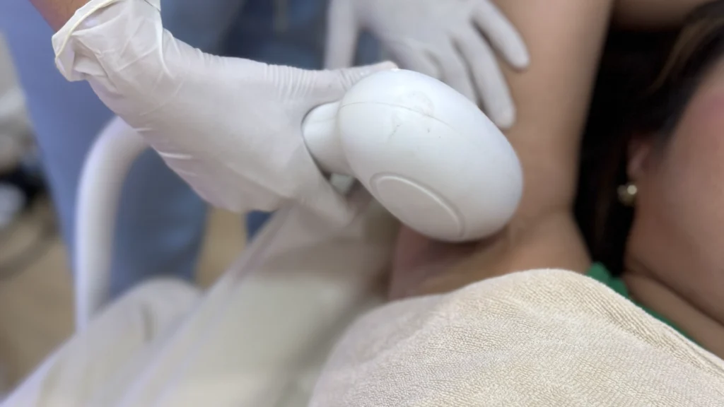 คุณหมอเอกกำลังทำเลเซอร์กำจัดขนด้วย Diode Laser
